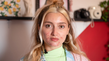 I Didn't Get Acne Until I Turned 21