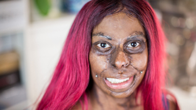 Mum Embraces Her Scars After Kerosene Explosion