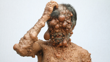 Dad’s Entire Body Is Covered In Tumours