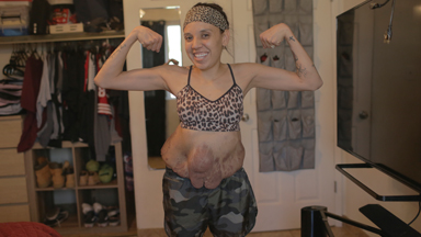 I’m Finally Ready To Show The World My Tumours
