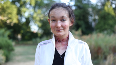 The Teenager With Butterfly Skin
