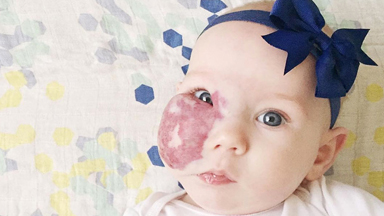 The big picture: Mum won't let birthmark define her daughter's beauty