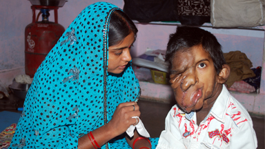 Facial Tumour: Community Rallies To Give Boy New Hope