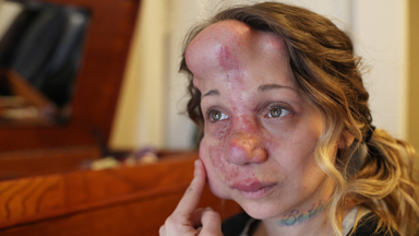 Woman With Balloons In Her Face Is To Undergo Reconstructive Surgery