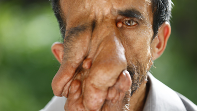 Nepalese man with facial tumour seeks life-changing treatment