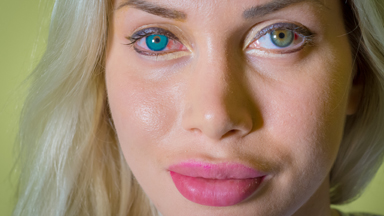 Custom Eyes: Pixee Fox Has Permanent ‘Cartoon’ Implants Fitted