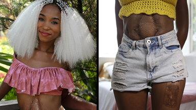 Car Crash Scars Won't Kill My Modelling Dreams
