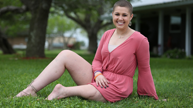 My Ankle Is My Knee: Beauty Queen Has Cutting-Edge 'Rotationplasty' Surgery
