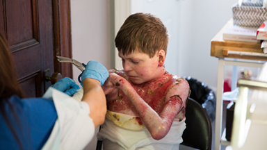 Teenager With Butterfly Skin Inspires Others
