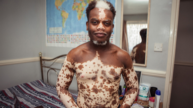 My Vitiligo Is Disappearing - But I Don’t Want It To