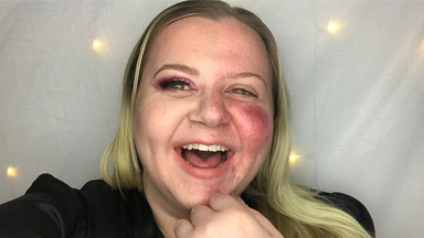 Why I Won't Hide My Lupus Anymore