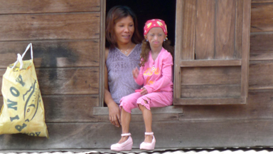 Progeria Teen Starts Drug Trial In Bid To Live Way Into Her Twenties