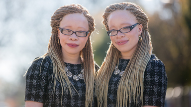 Twins With Albinism Wear Their Condition With Style