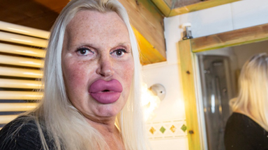 Surgery Obsessive Spends $76,000 In Quest for Perfection