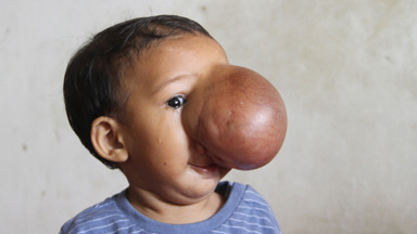 Baby's face eclipsed by life-threatening tumour