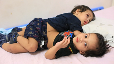 The Conjoined Twin Brothers Who Survived Separation