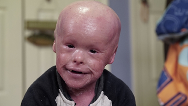 Harlequin Ichthyosis: The Boy Whose Skin Grows Too Fast