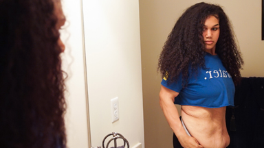 I Lost 200lbs But Felt Trapped In My Excess Skin