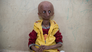 Inspirational young boy with ultra rare genetic condition defies doctors to celebrate his fifteenth birthday