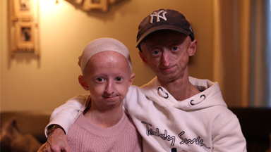 The Brother And Sister Who Age Too Fast