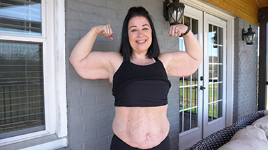 I Lost 230lbs But Can Surgery Fix My Excess Skin?
