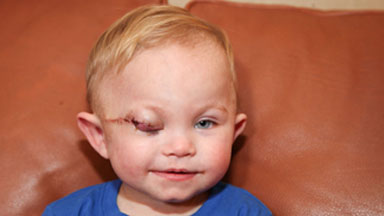 Brave Toddler Colby Has Sight-Saving Surgery On Tumour