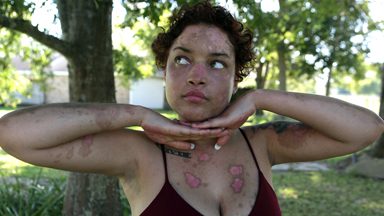 My Lupus Blisters Won’t Hold Me Back