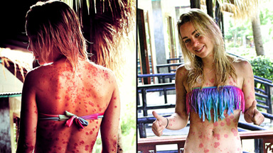 I Don’t Want To Get Rid Of My Psoriasis