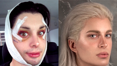 I've Had 32 Surgeries To Look Like An Elf