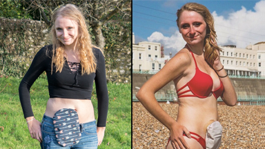 I’m Finally Proud Of My Ostomy Bag