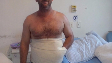 Surgeons Save Man's Hand By Sewing It Into His Stomach