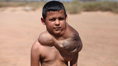 Boy With Giant Growth Saved By Life-Changing Surgery