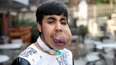 Body Bizarre: Stunt Bike Tumour Teen Undergoes Surgery
