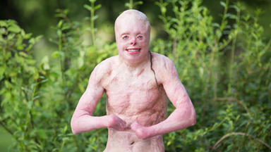 My Body With 95% Burns
