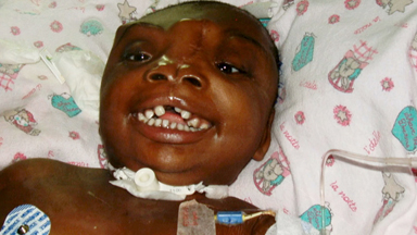 The Girl Without A Forehead: 3D Printed Template Helps Seven-Year-Old Grow Skull