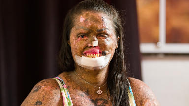 My Skin Condition Hasn't Stopped Me Finding Love