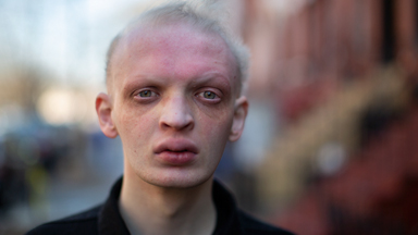 Modelling Helped Me Embrace My Rare Condition