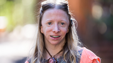 My Rare Facial Deformity Nearly Ruined My Life