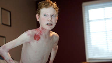 Butterfly Boy: Teen’s Delicate Skin Falls Off At The Slightest Touch