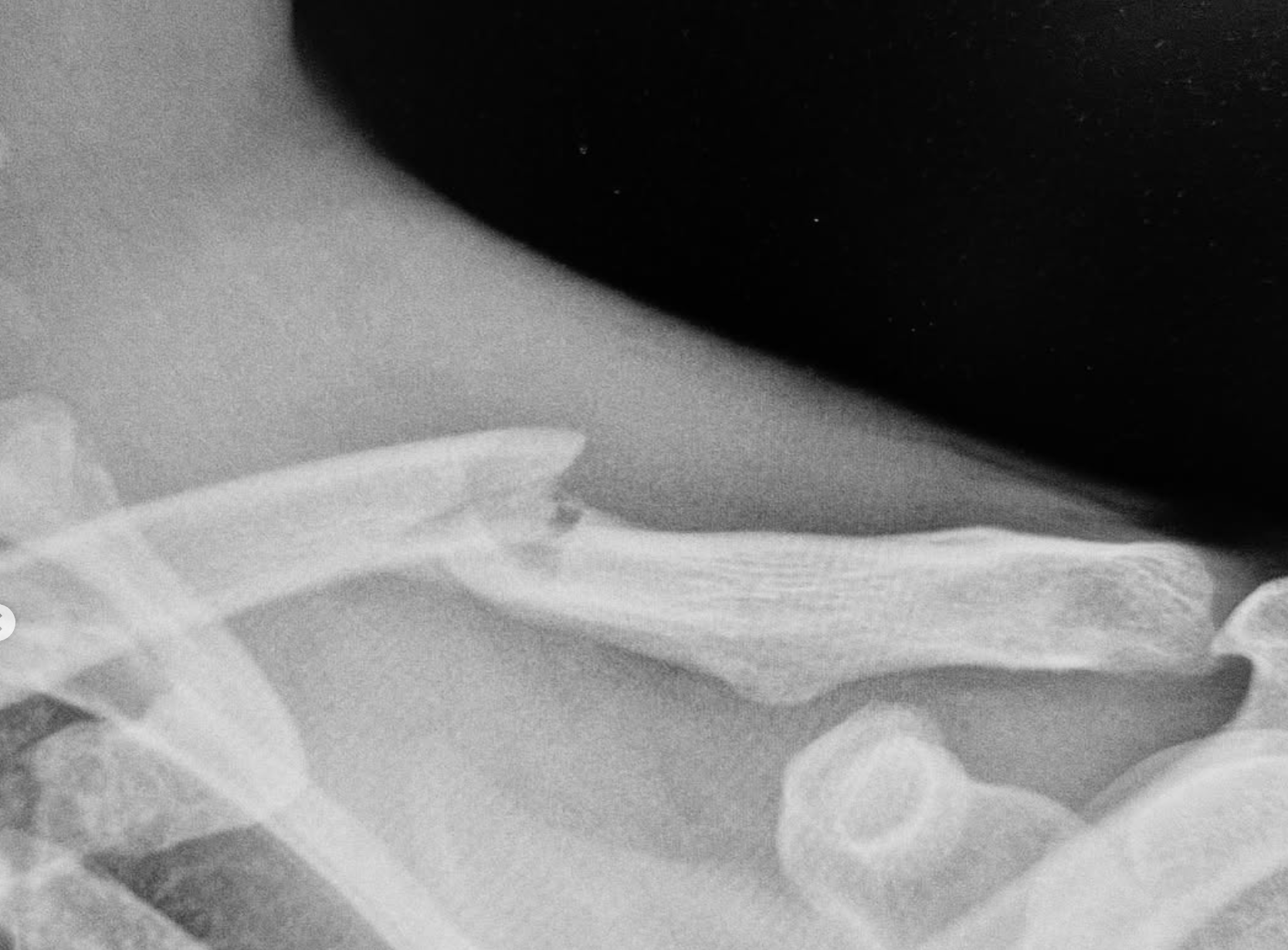 Emil Johansson injury Cairns 2025