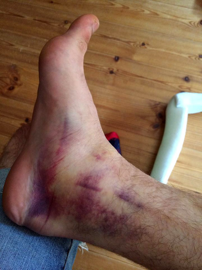So sah Adrian Warnkens Fuß am Montag nach der Pannonian Challenge aus