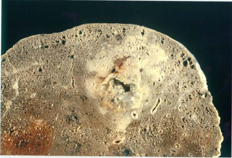 Section of the lung showing BR pattern