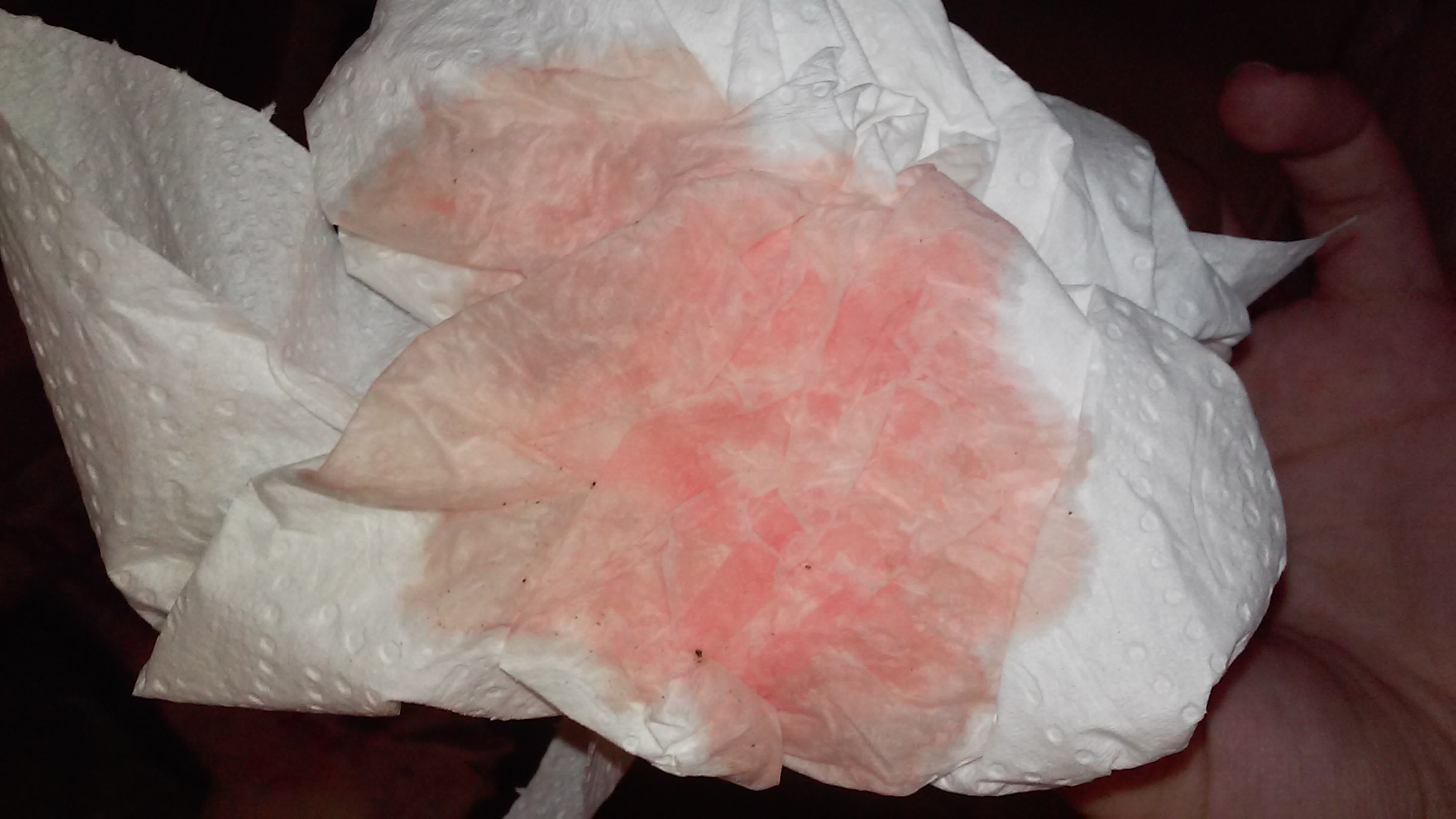 orinar con un poco de sangre orinar con un poco de sangre