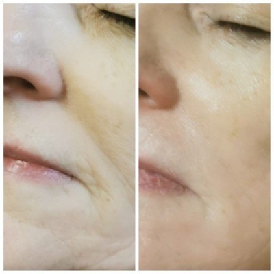 COLLAGEN LIFT