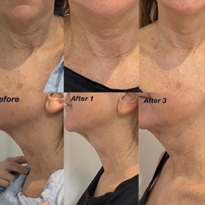 COLLAGEN LIFT