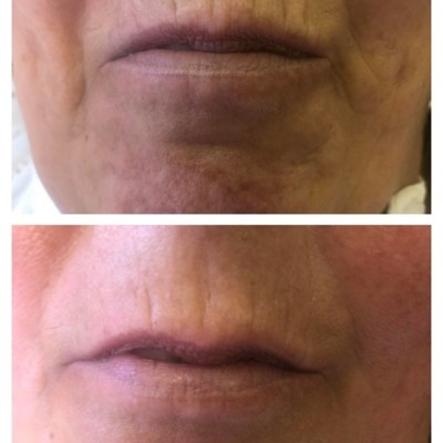 COLLAGEN LIFT