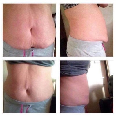 CYROLIPOLYSIS - FAT FREEZING
