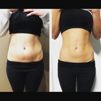 CYROLIPOLYSIS - FAT FREEZING