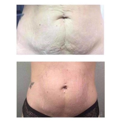 CYROLIPOLYSIS - FAT FREEZING