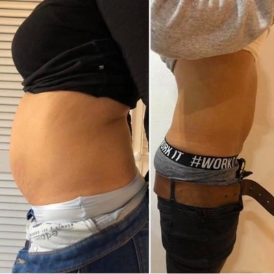 CYROLIPOLYSIS - FAT FREEZING